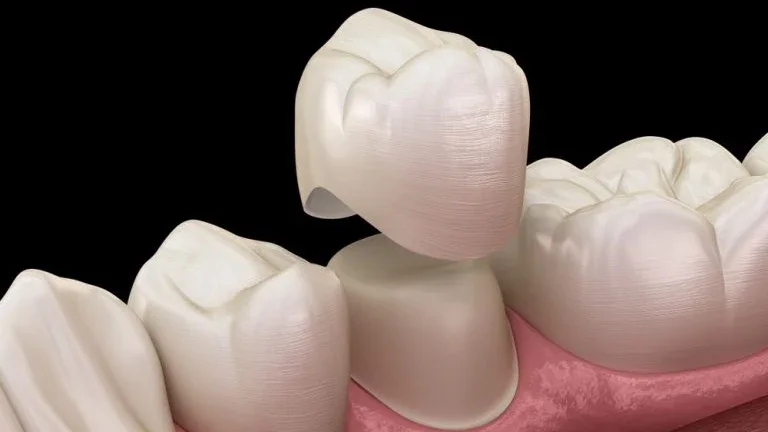 Dental restorations and careful repair of natural teeth