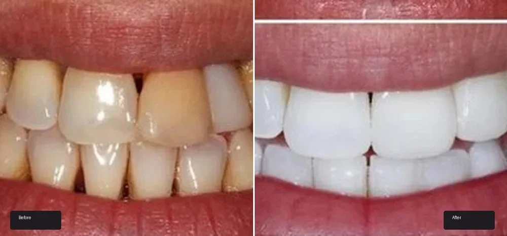 Documented smile transformation: before on the left, after on the right.