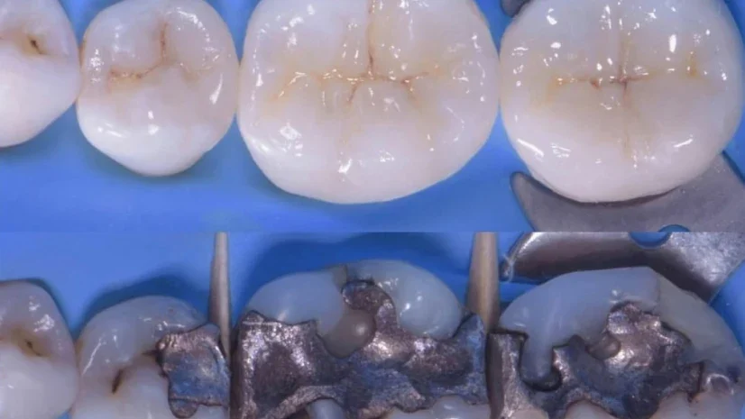 Dental restorations and careful repair of natural teeth