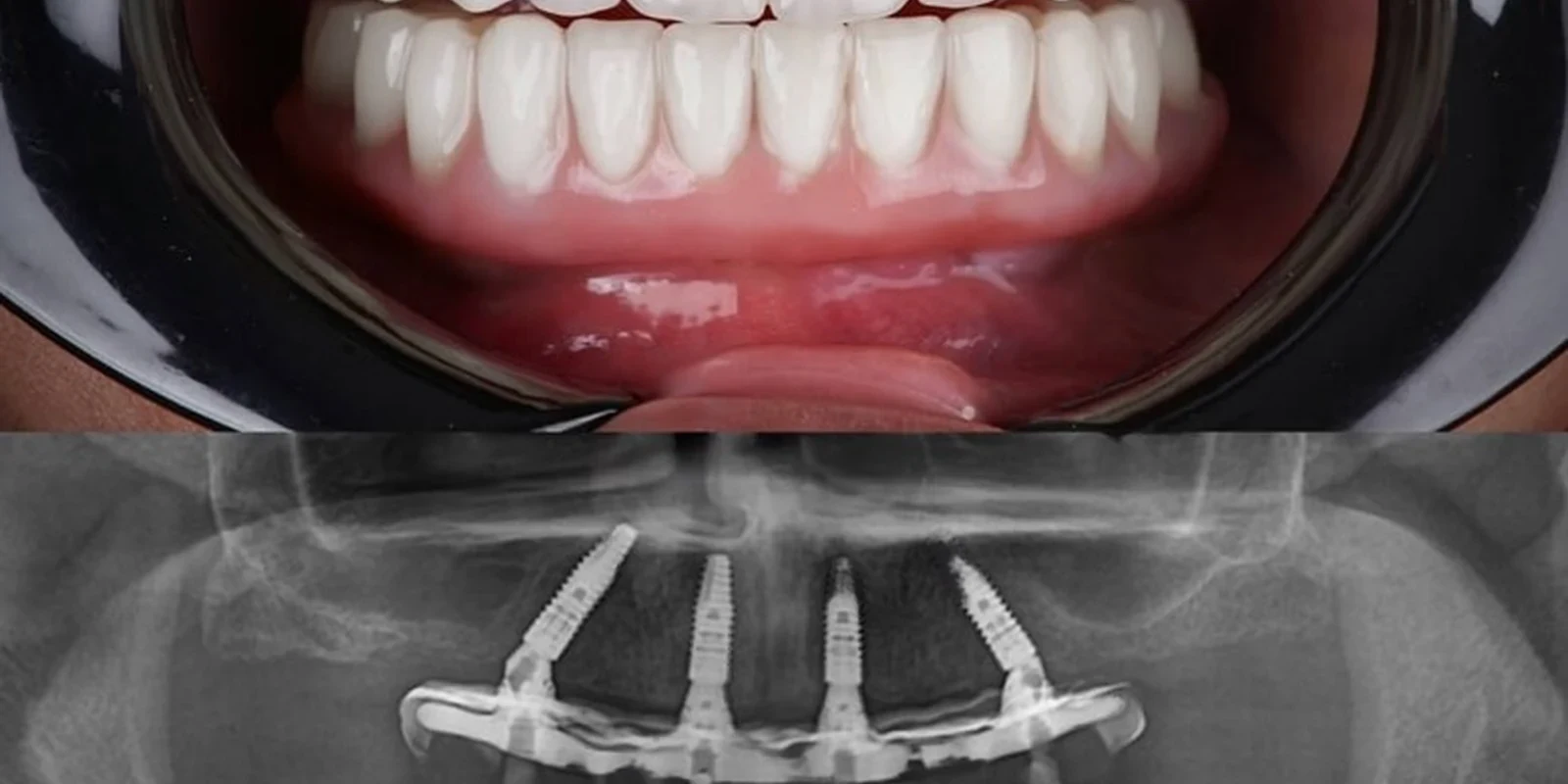 Dental implant consultation, planning and tooth replacement