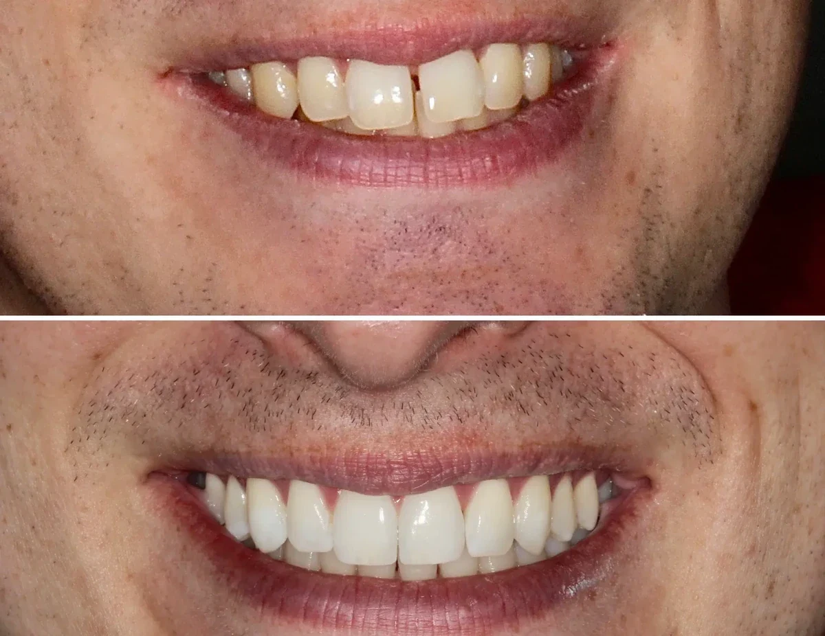 Smile after clear aligner treatment