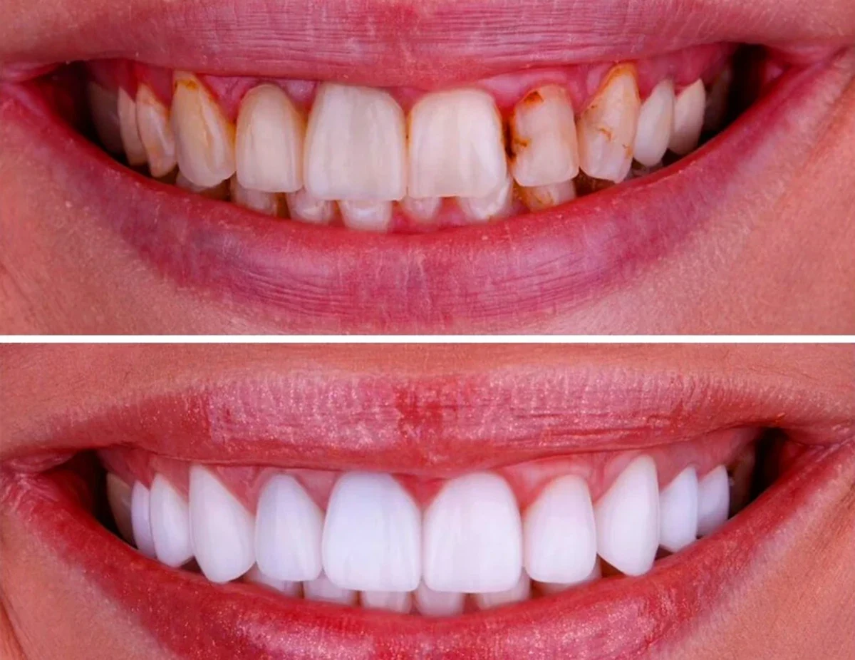 Composite bonding, dental contours and smile design