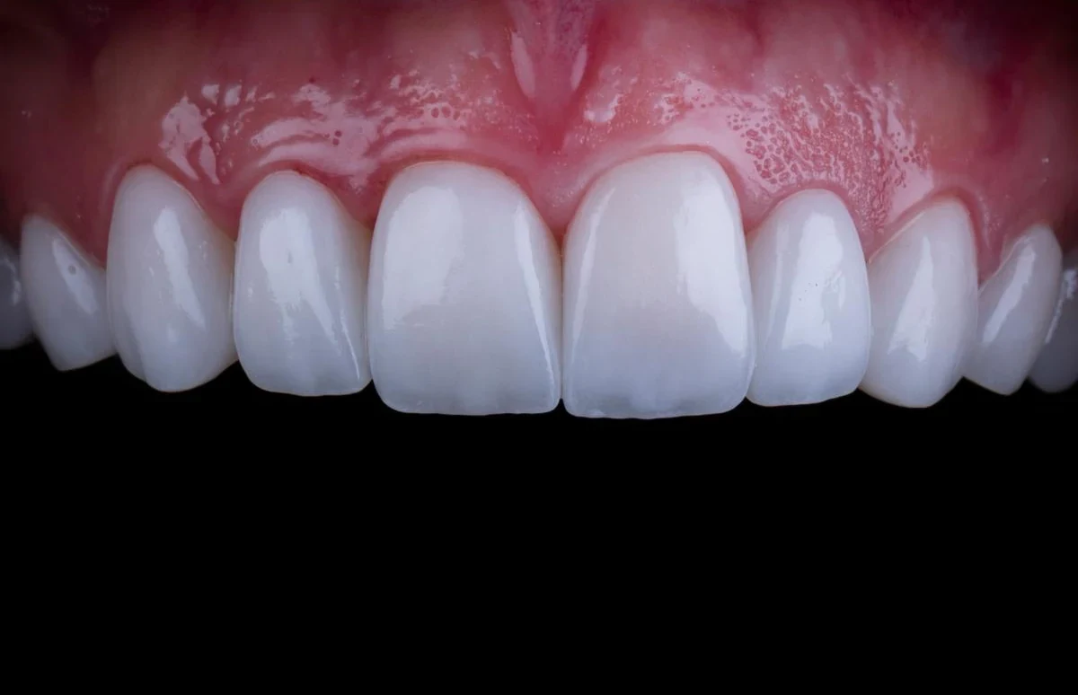 Cosmetic dentistry and carefully planned smile aesthetics