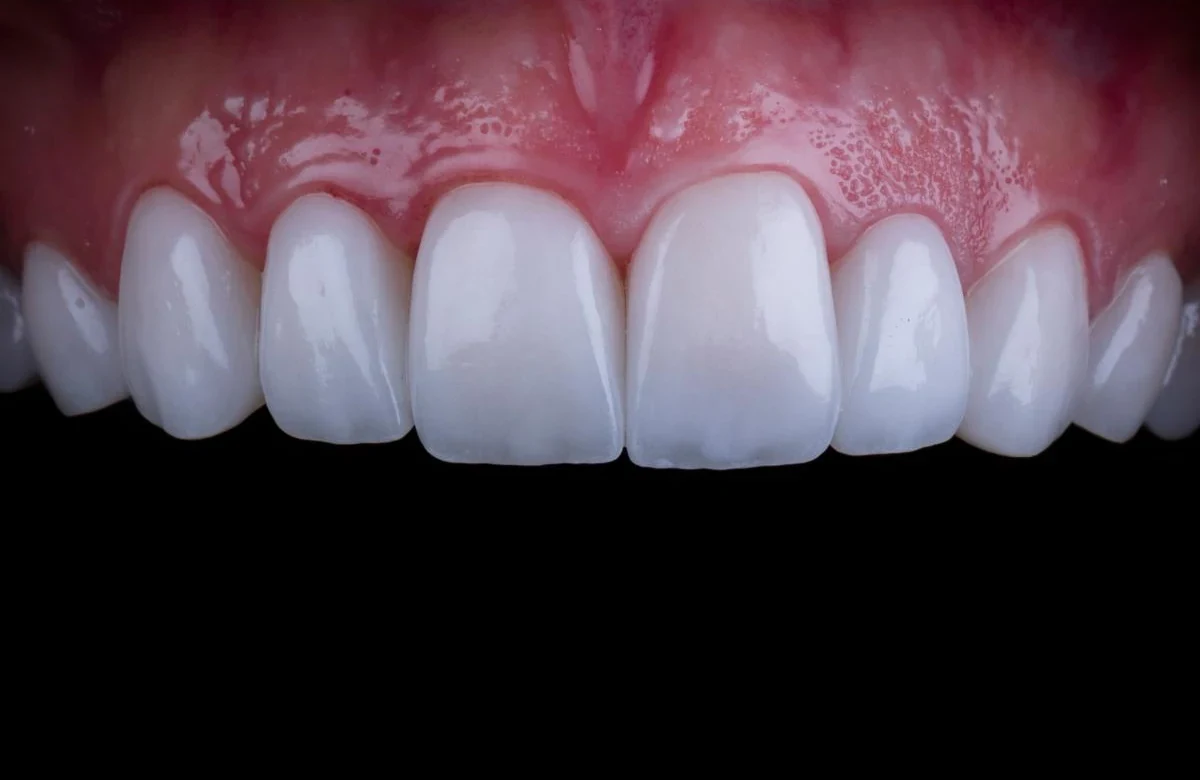 Cosmetic dentistry and carefully planned smile aesthetics