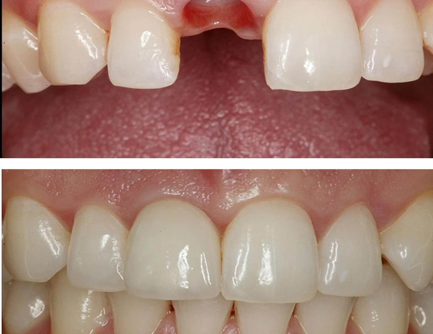 Before and after photographs illustrating the restoration of a missing upper front tooth