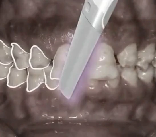 A dental instrument refining the surface of a tooth during restorative treatment.