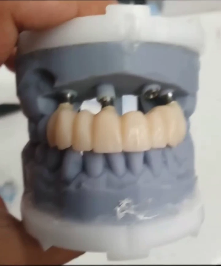 Ceramic restorations examined on a laboratory model.