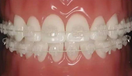 Fixed ceramic brackets and wire