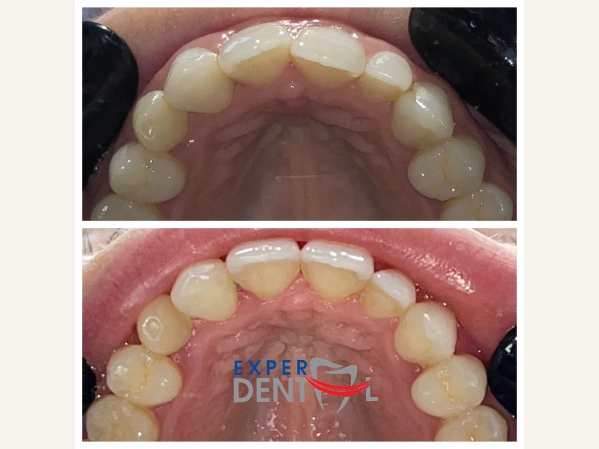 Upper and lower dental arches before and after fixed orthodontic treatment.