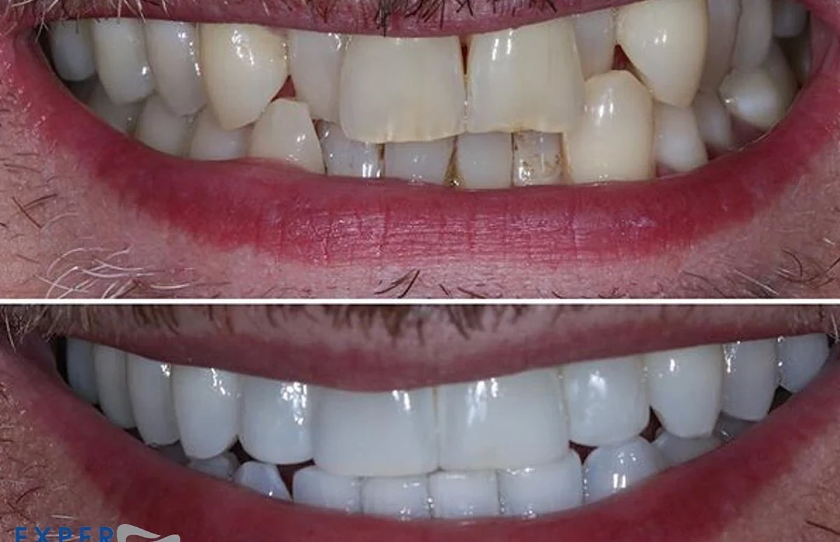 Invisalign: before (top) and after (bottom)
