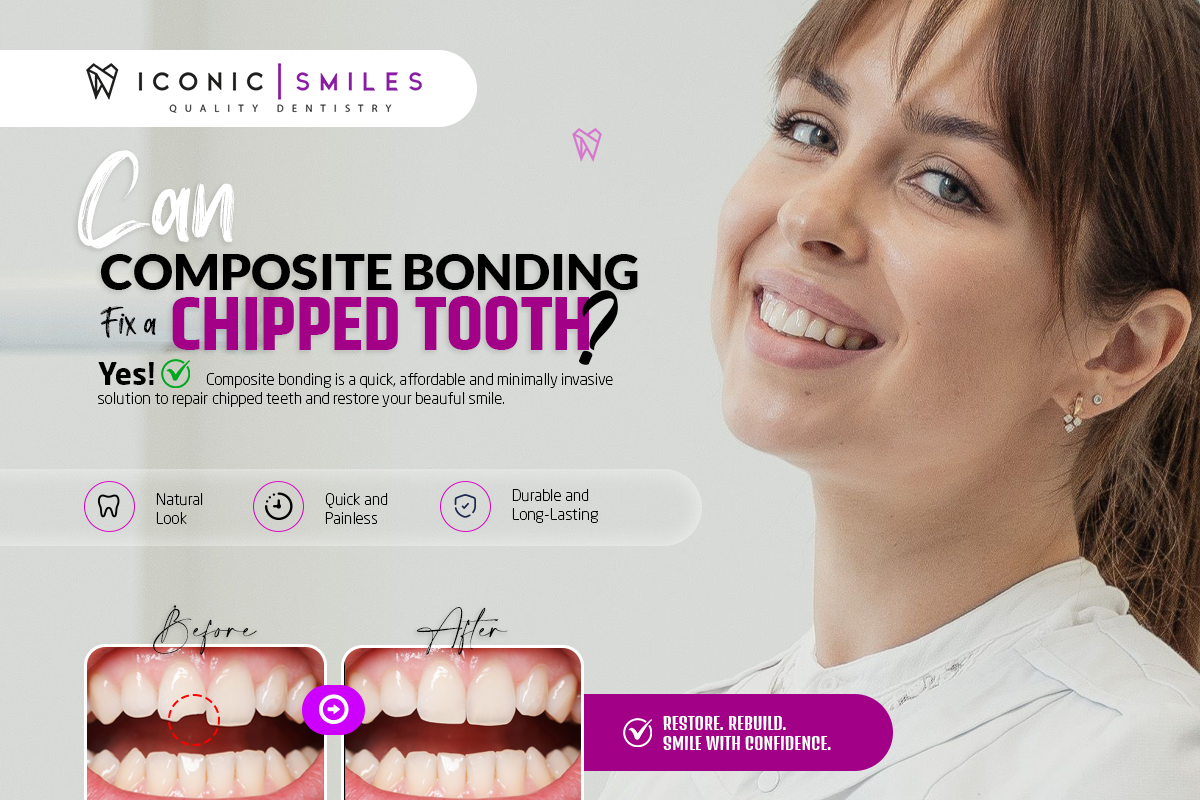 Composite Bonding for a Chipped Tooth | Iconic Smiles