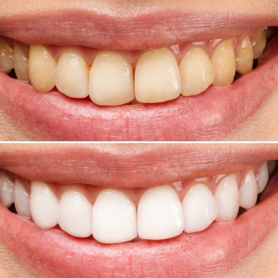 woman teeth before and after whitening. Over white background. Dental clinic patient. Image symbolizes oral care dentistry, stomatology
